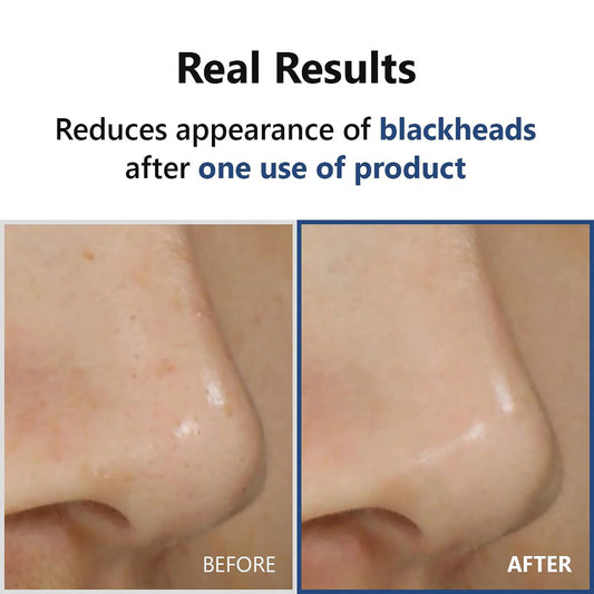 Hyper Acid4 Serum – Exfoliërend met AHA, BHA, PHA & LHA 20ml