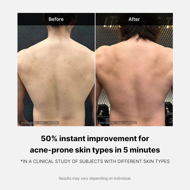 Red Acne Body Wash 2.0 – zuivert & kalmeert acne (400g)