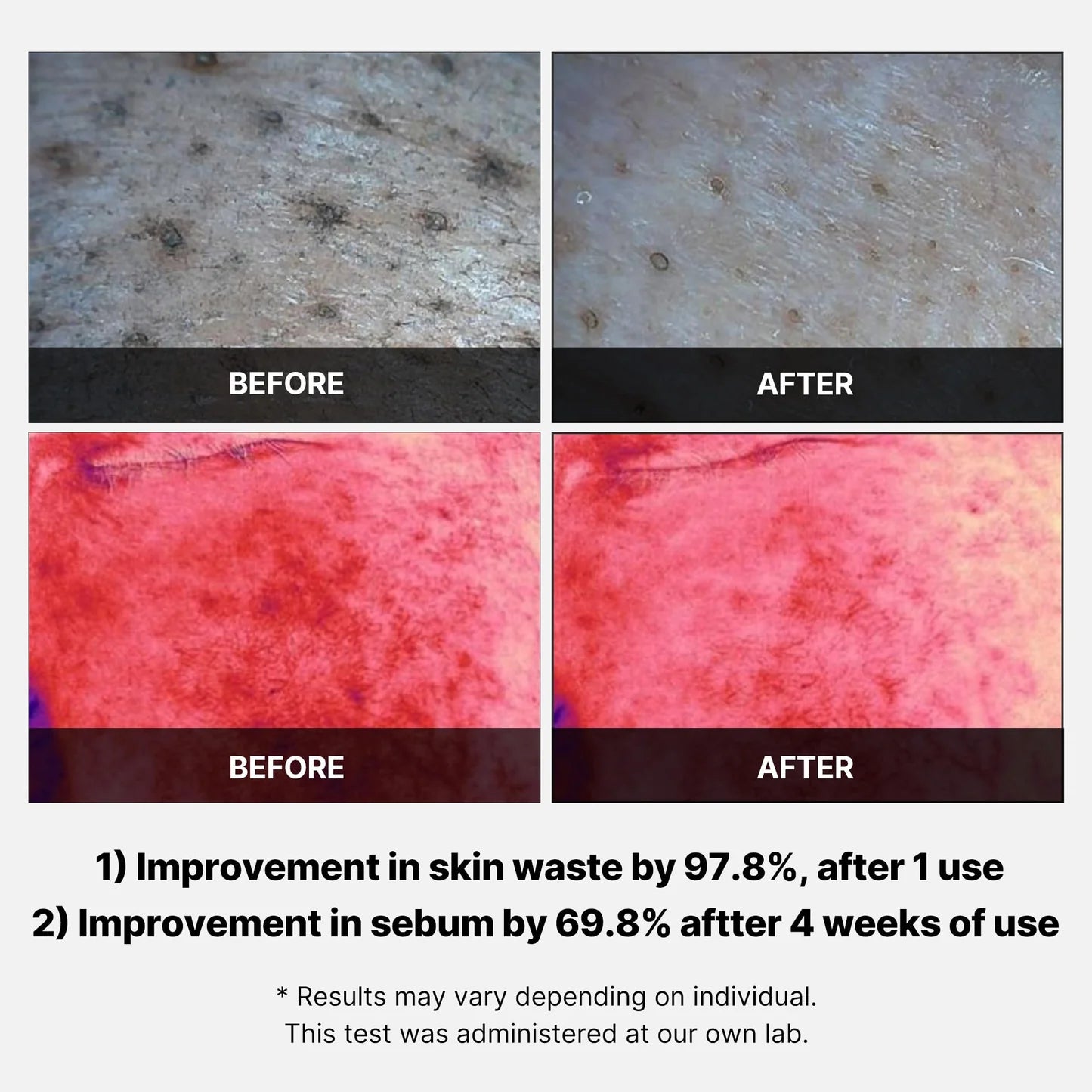 Red Acne Succinic Acid Peel (40g)