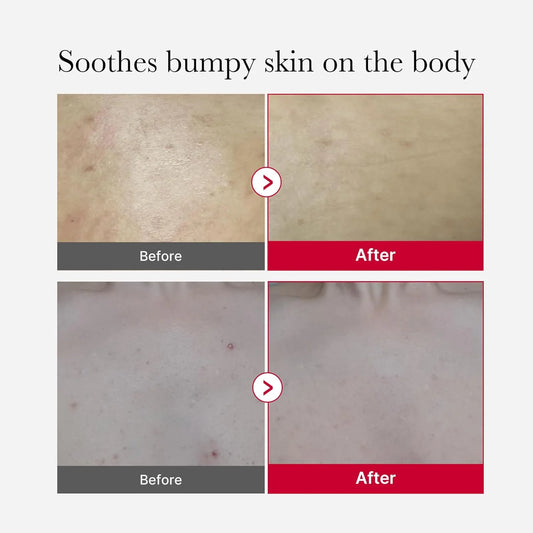 RED ACNE BODY PEELING SHOT 2.0 (110g)